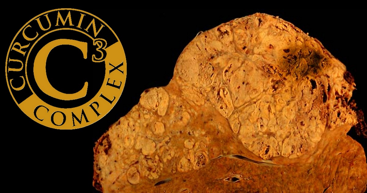 Curcumin and Taurine - Hepatocellular
