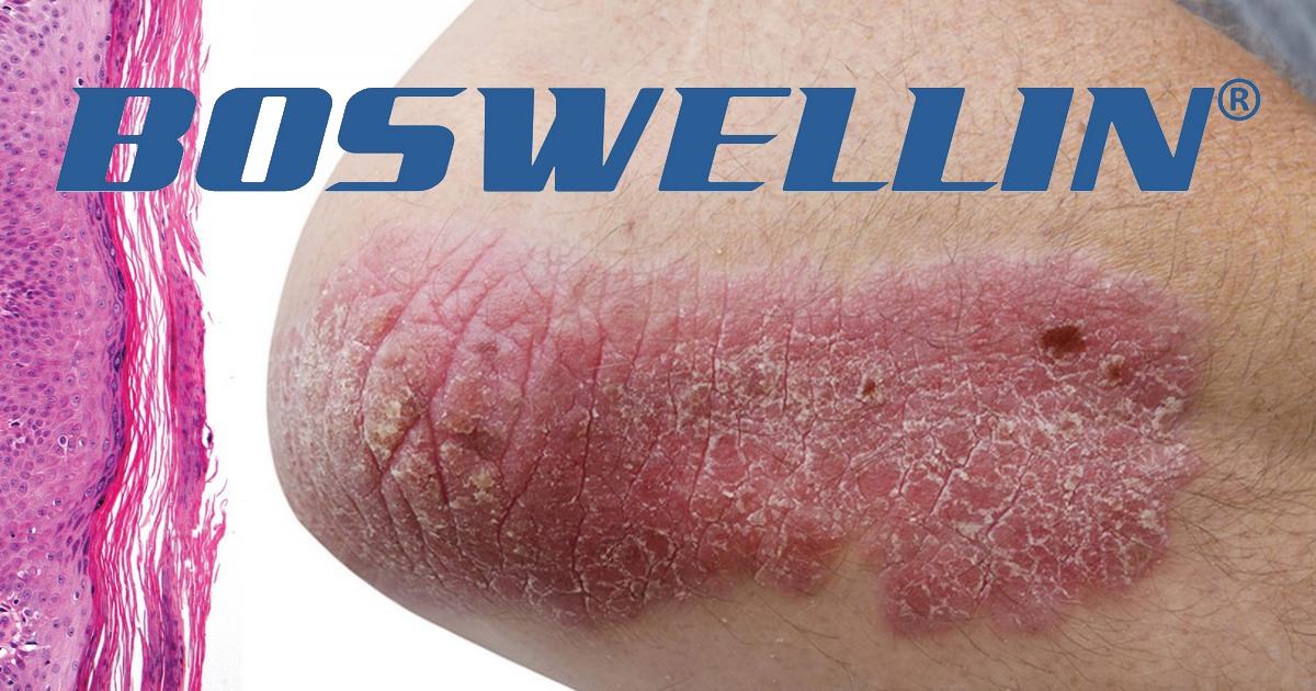 Boswellia cream and psoriasis